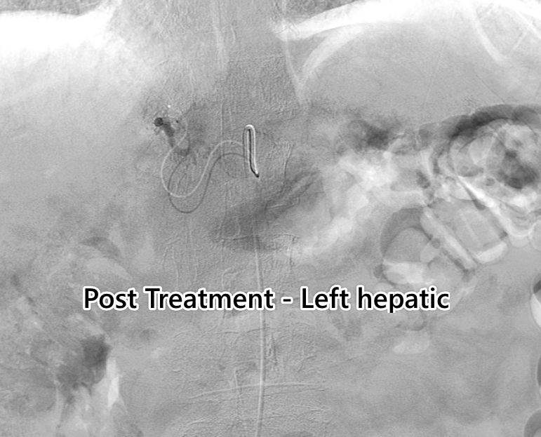 urmed_ir's tweet photo. 60 year old with HCC successfully treated with #Y90. Cancer doesn't care about COVID-19, so the show must go on. #Irad #MIIP #BasicIR #TwittIR #InnovationToHeal #Interventional #Radiology #Angio https://t.co/6Q1fVcl8RE