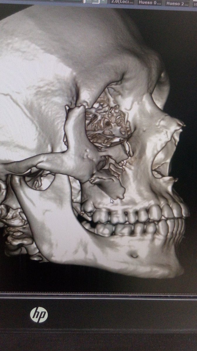 CHuentequeo's tweet photo. De vuelta a los pabellones del #HHHA con un gran equipo de amigos #Covid19Chile 
 
 #maxillofacial #traumamaxilofacial
#snorkel anticovid 
#HHHA
@TEMUCOHHHA 
@temuco
#facialtrauma https://t.co/DmgJtJlto0