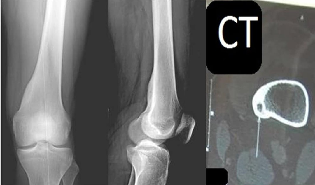 drhiteshg's tweet photo. 20 year old male with pain in the distal medial thigh. What's your diagnosis? 

A.  #Osteoblastoma
B.  #Chondroblastoma
C.  #Osteoid osteoma
D.  #Fibrous cortical defect

Follow us on instagram
https://t.co/yoLBHQS2l2

#FOAMed #FOAMrad #research #AcademicTwitter #medtwitter https://t.co/LPpT29aCl3
