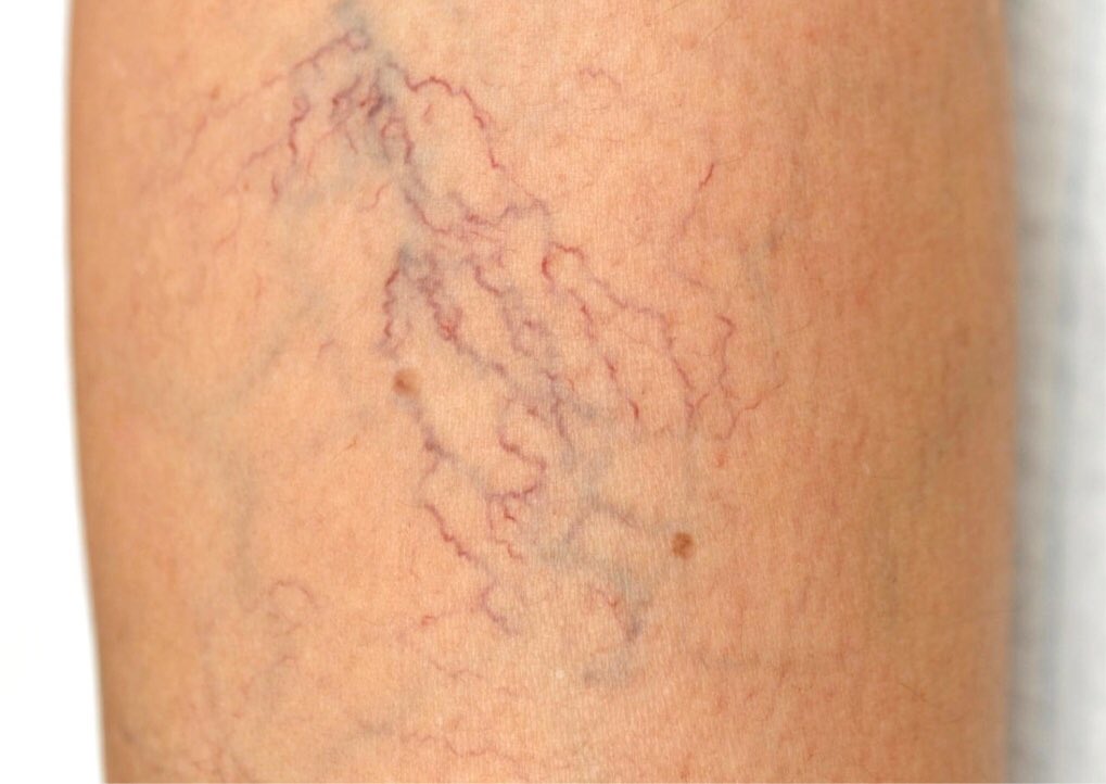 From varicose veins to cancer, what are those lumps down there