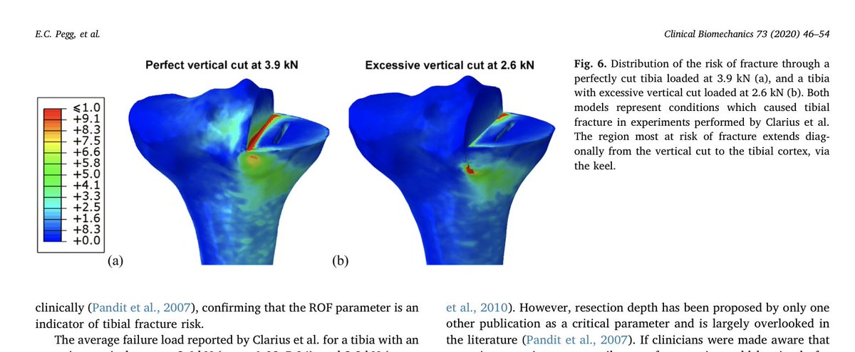 OOEC_Oxford's tweet image. Minimising tibial fracture after unicompartmental knee replacement:
sciencedirect.com/science/articl… @elisepegg @ProfRichieGill #bone #FEA #finiteelement #fracture