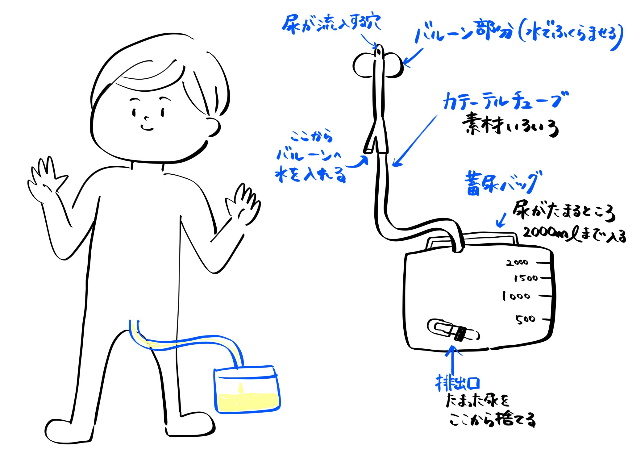 まなてぃ 訪問看護 イラスト 在 Twitter 上 訪問先の利用者様に膀胱留置カテーテル入ってる方が結構多くて 意外と先生から詳しい管理方法とか指導受けずに困ってる相談を受ける 説明しやすいように医療者じゃなくてもわかるように簡略化してまとめてるんやけど