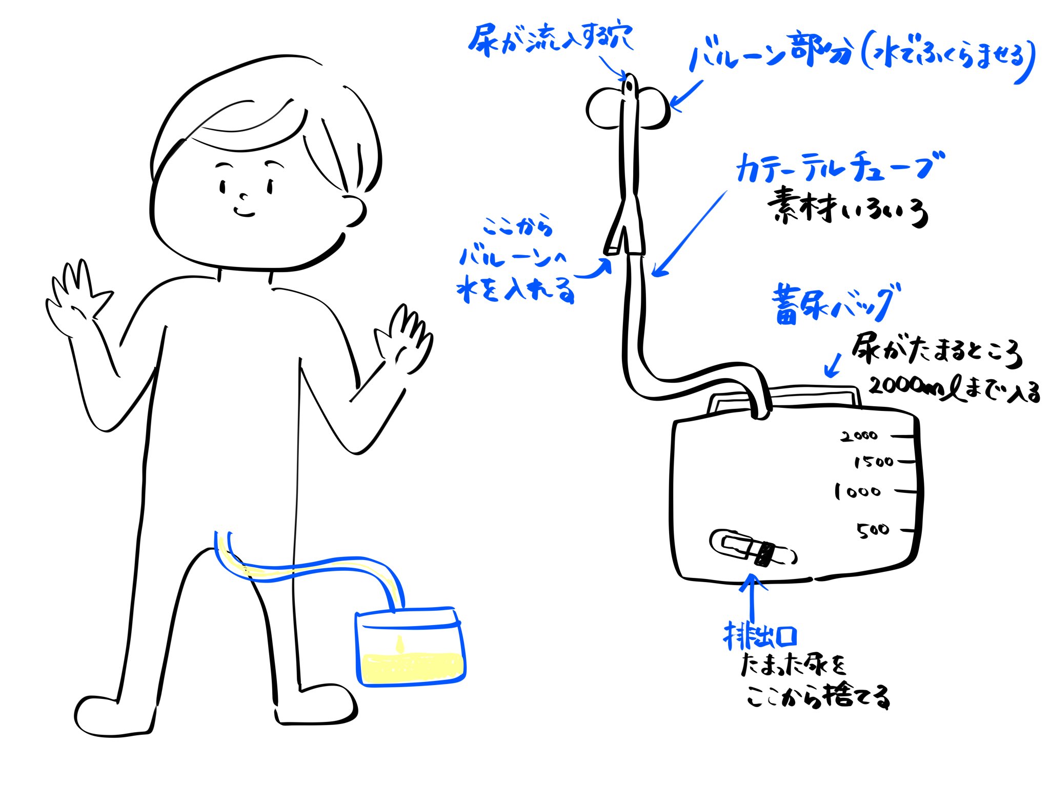 まなてぃ 訪問看護 イラスト 訪問先の利用者様に膀胱留置カテーテル入ってる方が結構多くて 意外と先生から詳しい管理方法とか指導受けずに困ってる相談を受ける 説明しやすいように医療者じゃなくてもわかるように簡略化してまとめてるんやけど Ipadっ