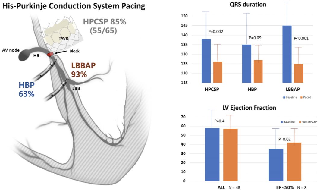 JACCJournals's tweet photo. New #HRSScience2020 from Drs. @hisdoc1 @psharmadoc @ocanoperez @jskoruth et al. finds His-Purkinje Conduction System Pacing is feasible &amp; safe in pts post-#TAVR. Explore the data, simultaneously published w/ @HRSonline's scientific sessions in #JACCCEP. https://t.co/0Rug0oNuuL https://t.co/PqJOVnPWVn