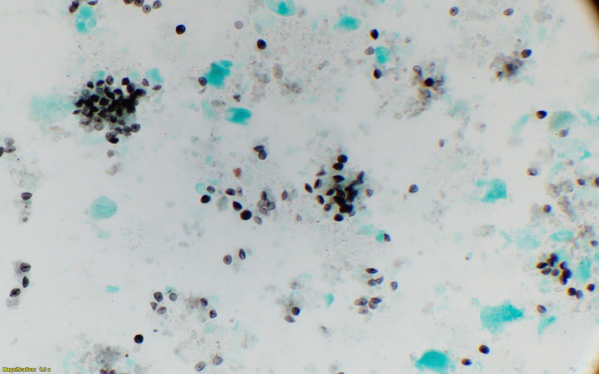 SurgePath's tweet photo. Guess the organism...#cytopath #pathology @sayak_ghatak @Marykingir @ac_pathgal https://t.co/xguLAXOywc