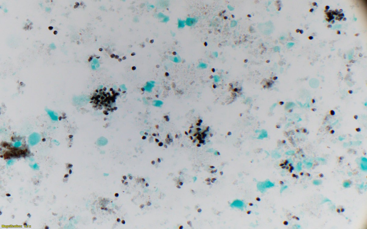 SurgePath's tweet photo. Guess the organism...#cytopath #pathology @sayak_ghatak @Marykingir @ac_pathgal https://t.co/xguLAXOywc