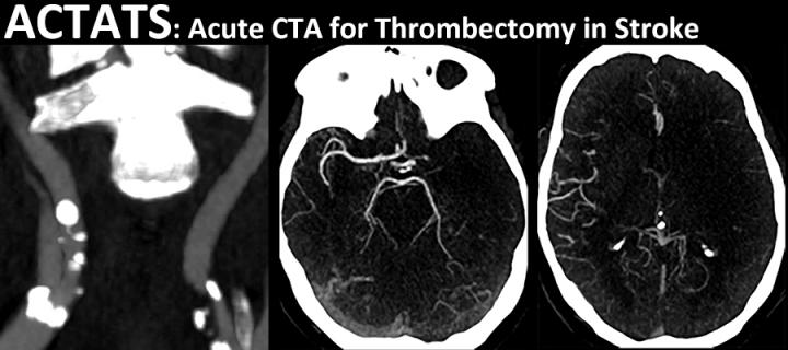 EdinUniNeuroImg's tweet photo. The Edinburgh Imaging Academy launched the Acute CTA for Thrombectomy in Stroke (ACTATS) training tool today. @EdinUniImaging @MedtronicUK @NHSNSS @IST_3 #EdinburghImagingAcademy #ComputedTomographyAngiography #Thrombolysis #Thrombectomy #Stroke https://t.co/3ZH27UnaaG https://t.co/7B3pyVrxdh