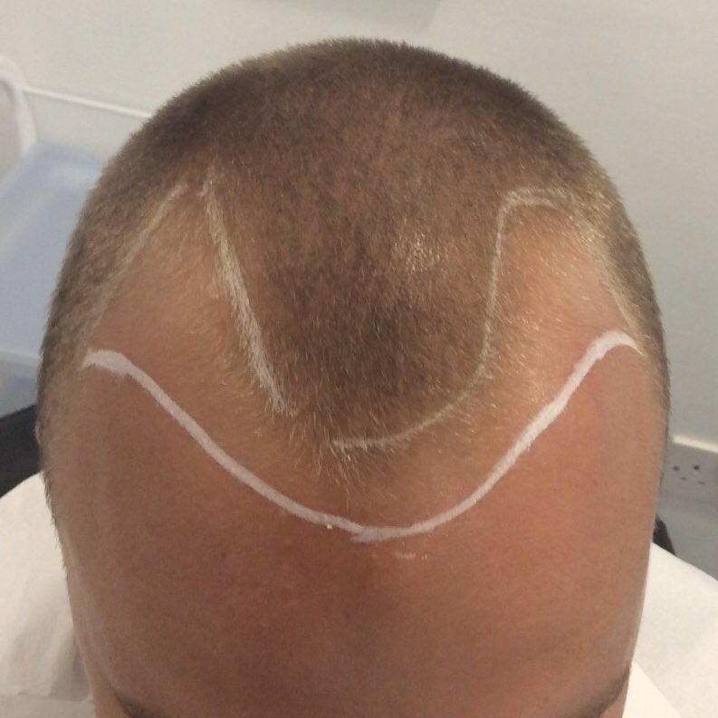 KSL_Clinics's tweet photo. ๐ 18 months following an FUE procedure and Jordanโs hair is looking sicker than ever ๐โฃ
โฃ
#KSLClinic #DrMatee #OnlineConsultation #FUE #FUEProcedure #FUEHairTransplant #HairTransplant #HairTransformation #HairRestoration #HairLoss #BeardTransplant https://t.co/CKNfY5EIg0