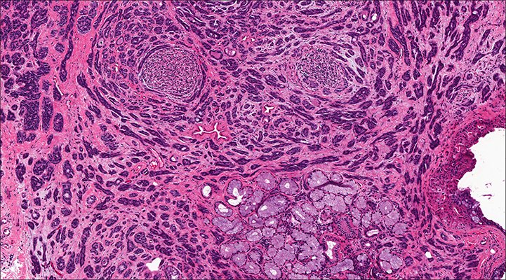 мезонефроидная аденокарцинома матки гистология. аденокарцинома простаты гистология. ацинарная аденокарцинома предстательной железы микропрепарат. каналикулярная аденома. мелкоацинарная аденокарцинома предстательной.