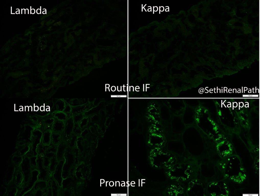 SethiRenalPath's tweet photo. Pronase IF critical in Light Chain Proximal Tubulopathy. Routine IF completely negative, but pronase IF shows kappa light chains with crystalline shapes. LM showed ATN. I would have missed the LCPT diagnosis if I did not perform pronase IF. 55-yr woman with CKD and abnormal FLC. https://t.co/8oWOKmuwXT