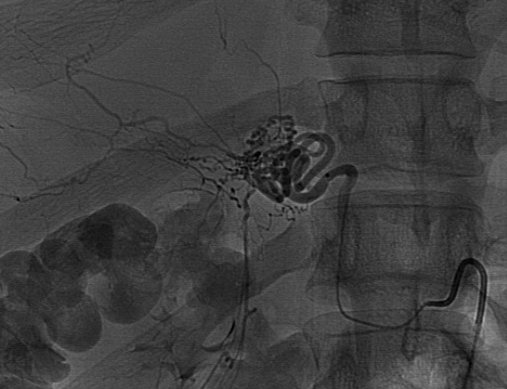 DMaldowMD's tweet photo. 32m w large hemorrhagic AML fed by middle adrenal and right renal branch. 355-500 um PVA particles took it off the grid. Enjoy all cases but especially this one with @andrew_cantos https://t.co/7envqMpxZw
