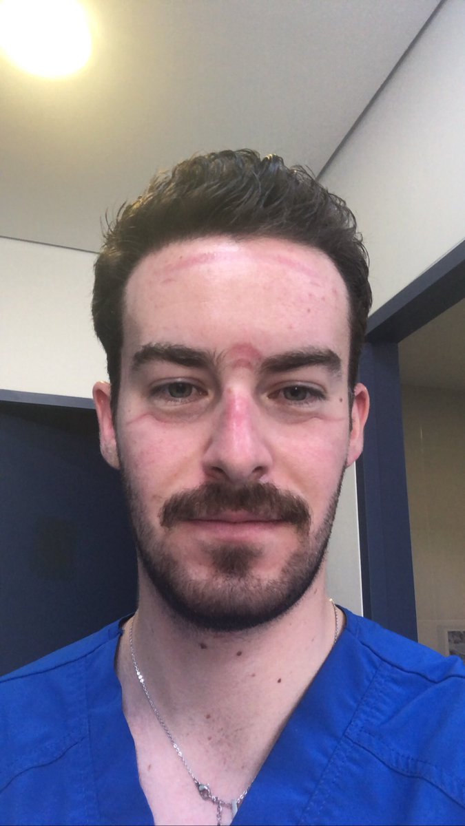 doctorozco's tweet image. Terminando de sacar “líquido de las rodillas”.