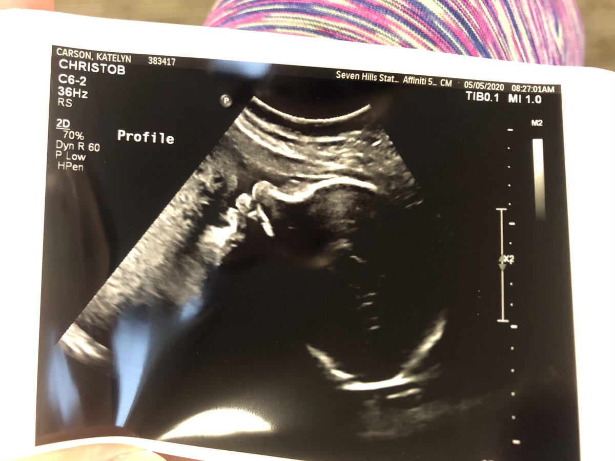 KKlayer's tweet image. 32 days my sweet miracle baby 💚