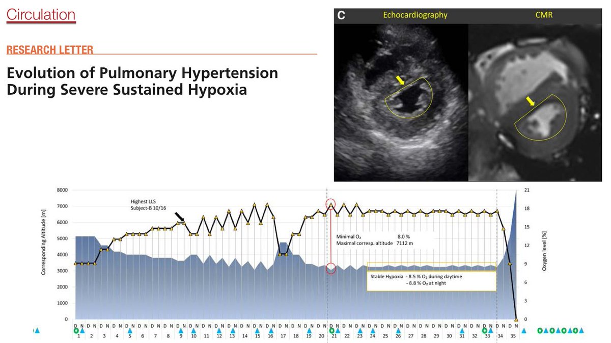 Happy Hypoxemia? How about casually living with an FiO2 of 8.5% for weeks! PaO2 of 33 mm/Hg.

Look👀 at that right ventricle suffering the consequences of hypoxic pulmonary vasoconstriction! Normal BNP and Troponins. #ThePeoplesVentricle is tough! doi.org/10.1161/CIRCUL…