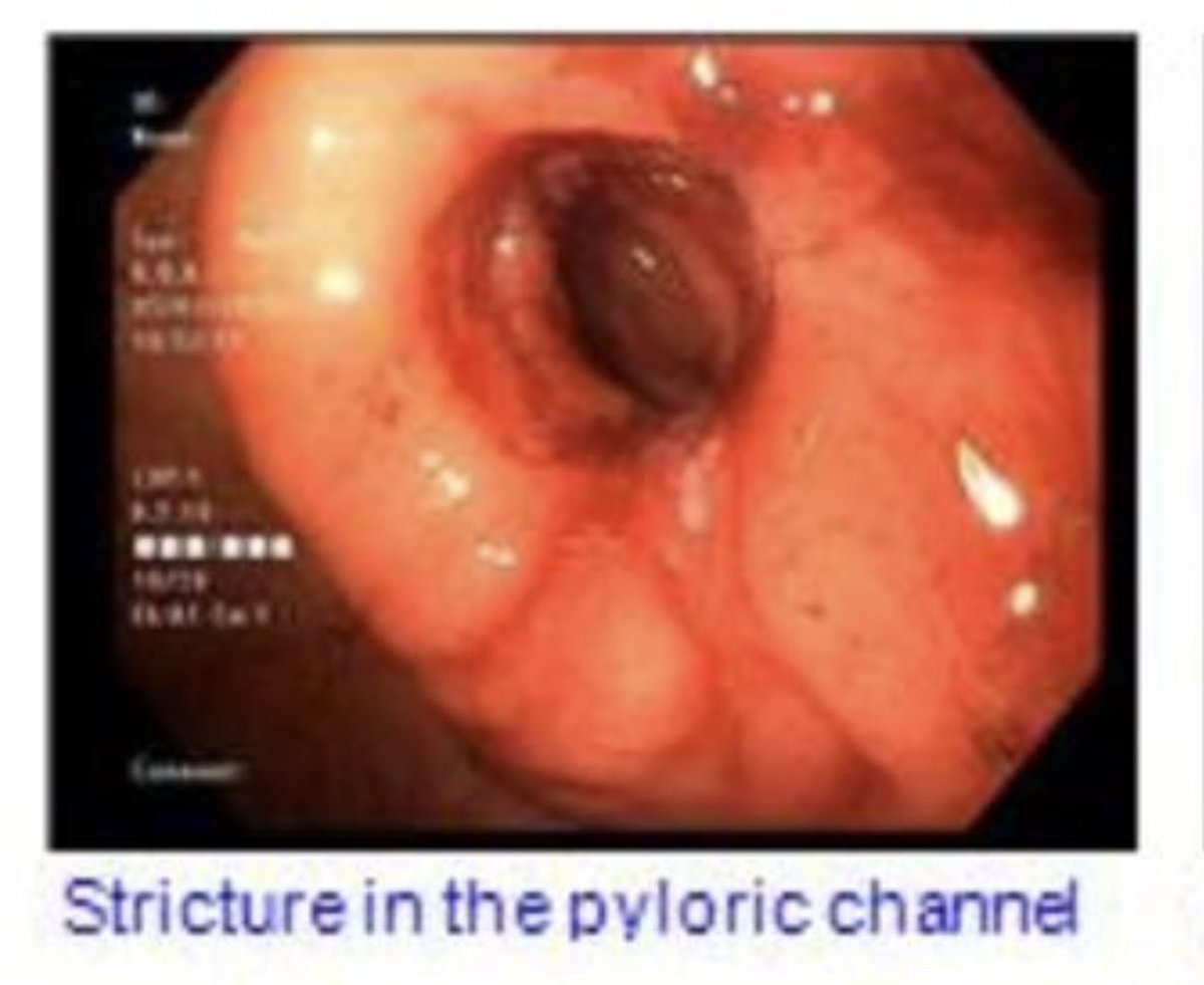 fahedjulien's tweet photo. Gastric outlet obstruction is one of the causes for intractable nausea and vomiting. #endoscopic dilation is very effective #GI #gastro #gastroenterology #minimallyinvasive https://t.co/yaahryk8mC