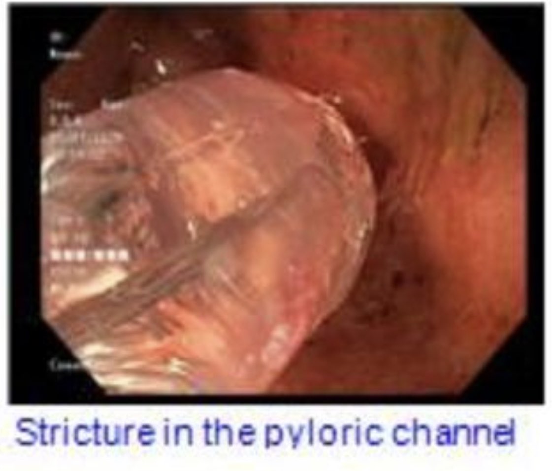 fahedjulien's tweet photo. Gastric outlet obstruction is one of the causes for intractable nausea and vomiting. #endoscopic dilation is very effective #GI #gastro #gastroenterology #minimallyinvasive https://t.co/yaahryk8mC