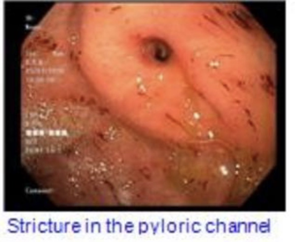 fahedjulien's tweet photo. Gastric outlet obstruction is one of the causes for intractable nausea and vomiting. #endoscopic dilation is very effective #GI #gastro #gastroenterology #minimallyinvasive https://t.co/yaahryk8mC