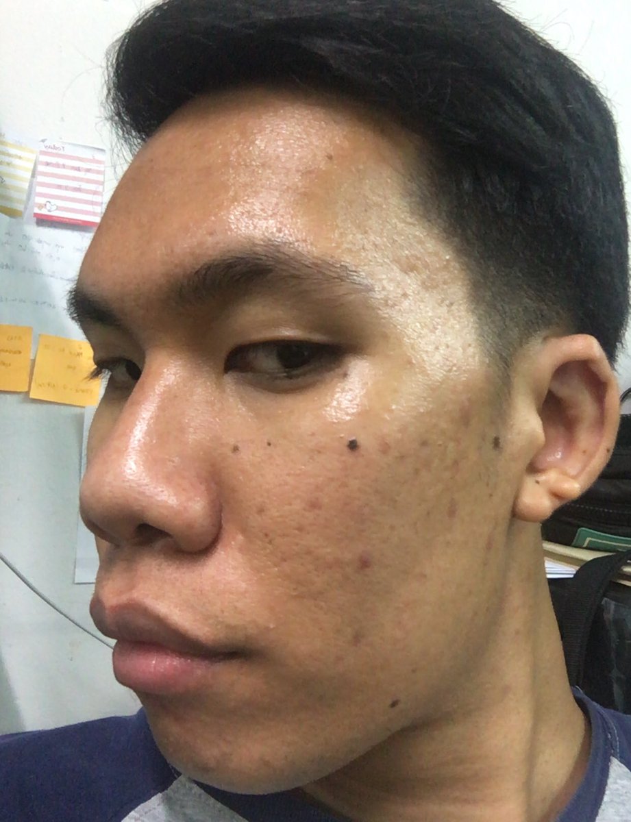 ssp6742's tweet photo. ทุกคนจะเชื่อไหมว่าเราผ่านวิกฤตนี้มาได้อย่างไร มันเป็นช่วงที่ทรมานมาก อายจนไม่กล้าจะออกไปเจอผู้คนเลย 
ตอนนี้เรามีสิ่งขาดไม่ได้เลยคือ 3 ตัวนี้ของ #Eucerin ทั้งหมด จากเมื่อก่อนเป็นสิวเยอะมาก ตอนนี้ขึ้นน้อยมาก ตอนเช้าใช้ MATT FLUID ตอนเย็นใช้ CLEARING ส่วนTonerทั้งเช้าเย็นเลย https://t.co/RI17XmCY9P