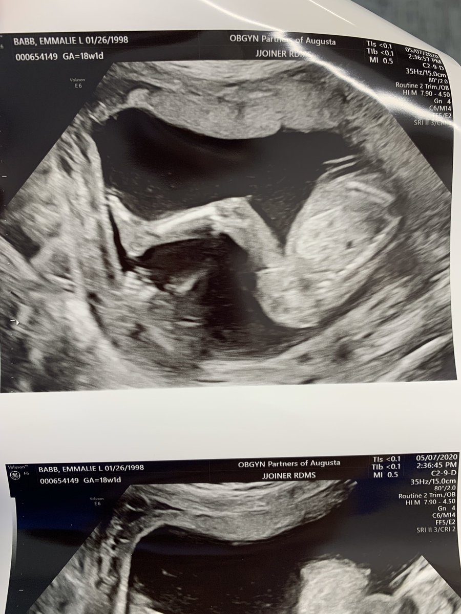 TheMamaBabb's tweet photo. Little bubba looks like he’s going to be a tall boy like his big bubba! He weighs 0.5 lbs right now and is healthy! I can’t wait to meet you my precious boy 💙 https://t.co/fafh53S12S