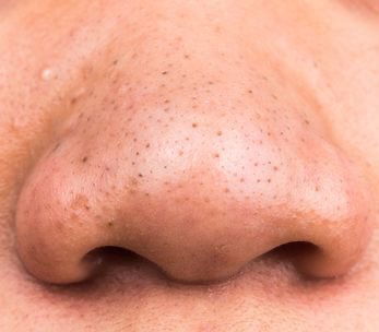 hannabunnyb's tweet photo. Sapa ada clogged pores 🙋🏻‍♀️🙋🏼‍♀️🙋🏽‍♀️
Tapi nak pakai acid AHA/BHA tak berani lagi? 

Ni list apa korang boleh buat ⤵️⤵️ https://t.co/EOP6cA3ODn
