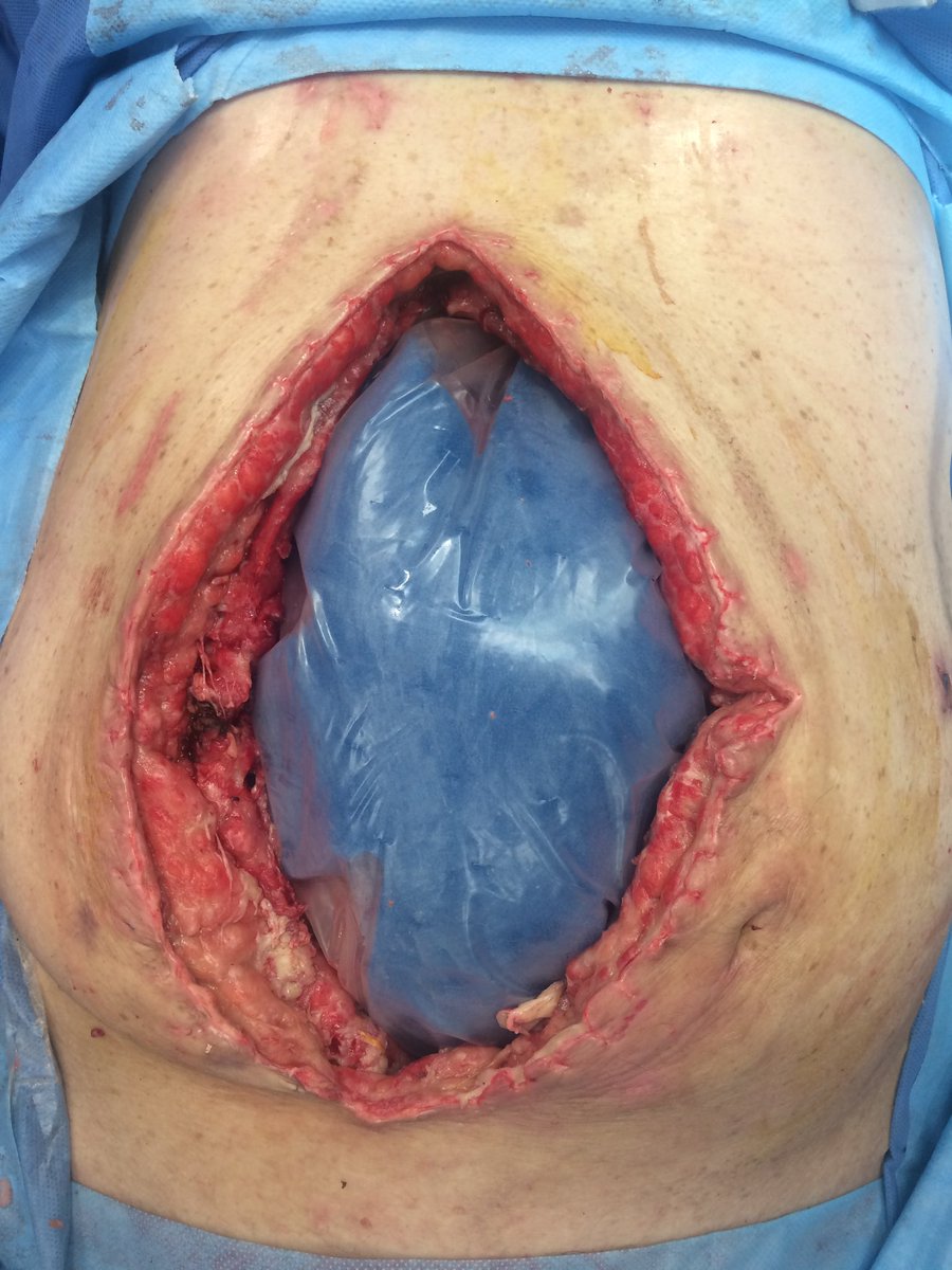 RodriguezParra_'s tweet photo. Ventajas de TPN en abdomen séptico: Sistema #ABThera 

✅Eliminar activamente líquido ⬇️ edema
✅Proporcionan tensión medial y ⬇️la retracción fascial y la pérdida de dominio
✅Ayuda a proteger el contenido abdominal
✅Permite acceso rápido para el reingreso y no requiere suturas https://t.co/nLc0W7avbE