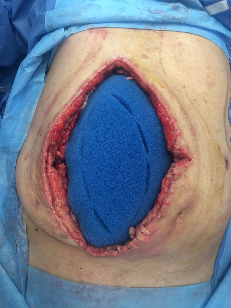 RodriguezParra_'s tweet photo. Ventajas de TPN en abdomen séptico: Sistema #ABThera 

✅Eliminar activamente líquido ⬇️ edema
✅Proporcionan tensión medial y ⬇️la retracción fascial y la pérdida de dominio
✅Ayuda a proteger el contenido abdominal
✅Permite acceso rápido para el reingreso y no requiere suturas https://t.co/nLc0W7avbE
