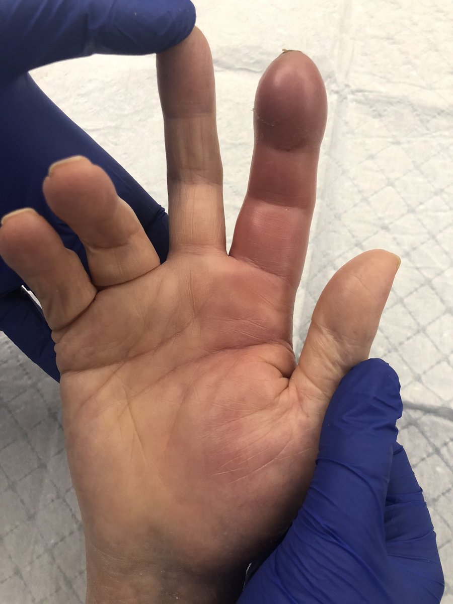 Yelena Bogdan, MD, FACS, FAAOS🦴🧚🏻\u200d♀️ on X: "Kanavel signs of flexor  tenosynovitis: finger held in flexion, pain along flexor tendon sheath,  fusiform swelling (“sausage digit”), pain with passive extension. Treated  by various