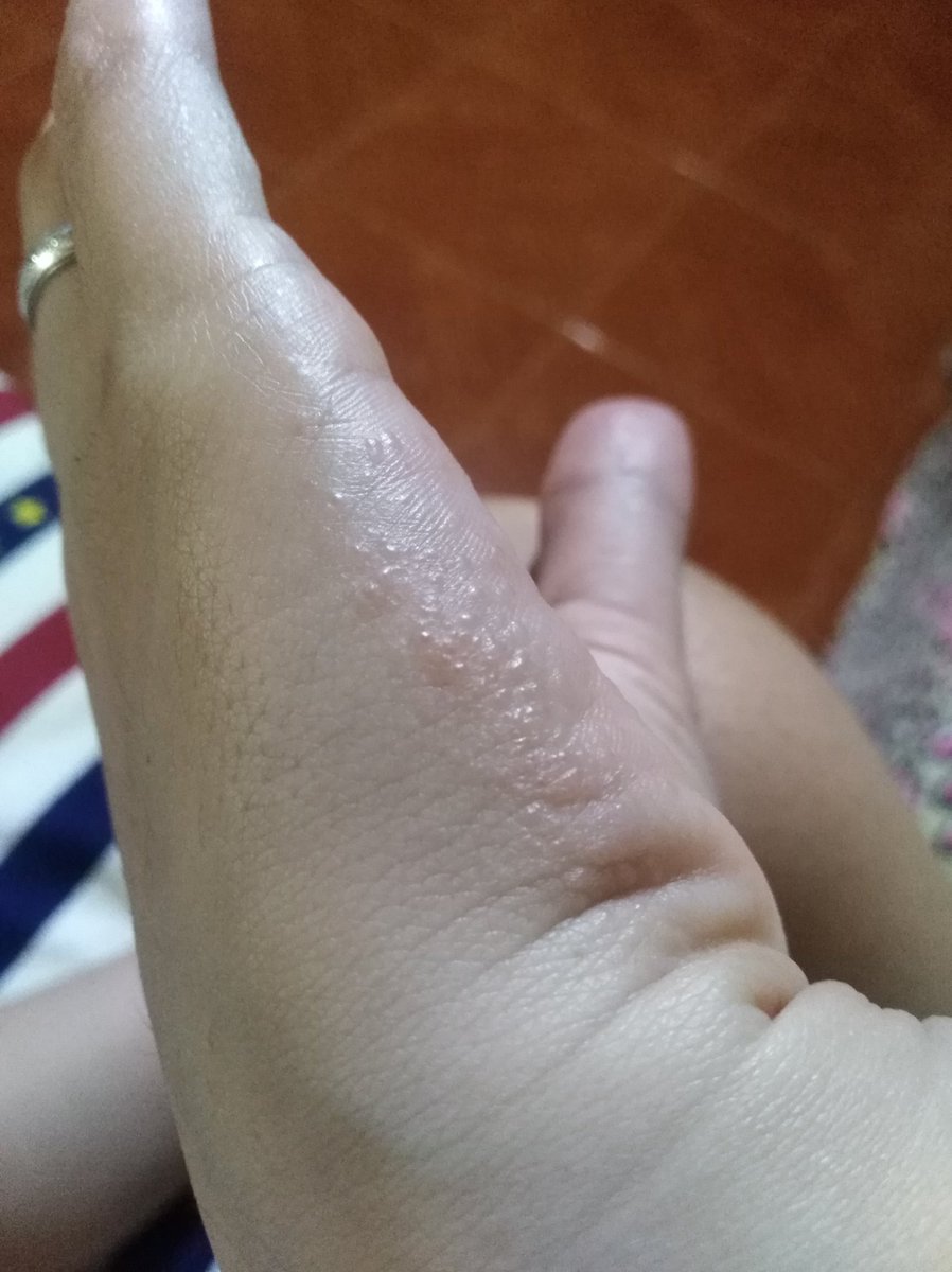 wilabJA's tweet photo. Allergy be like 🙍🤦 https://t.co/OlE5hNfGgs