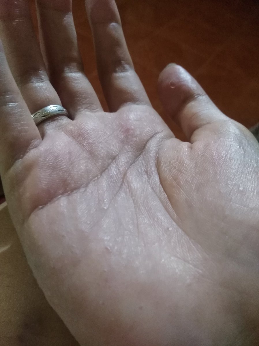 wilabJA's tweet photo. Allergy be like 🙍🤦 https://t.co/OlE5hNfGgs