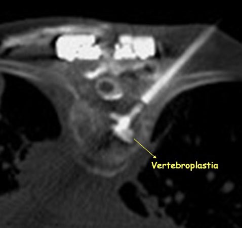 MarceloBordalo's tweet photo. Treating metastatic spinal cord compression with radiofrequency ablation and vertebroplasty. A viable therapeutic option. #irad #metastaticcompression #spinalcord #cordcompression #spinalradiofrequencyablation #oncologicspine https://t.co/CcadwwBvDz