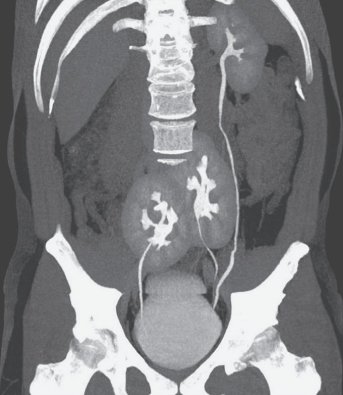 La imagen literalmente extraordinaria que nos regalan los brasileños 🇧🇷: 👨🏻 38 años consulta por dolor lumbar, le piden una TAC y se encuentran 3 riñones. La imagen es del <a href="/NEJM/">NEJM</a>
#Cirugía #Cirujanos