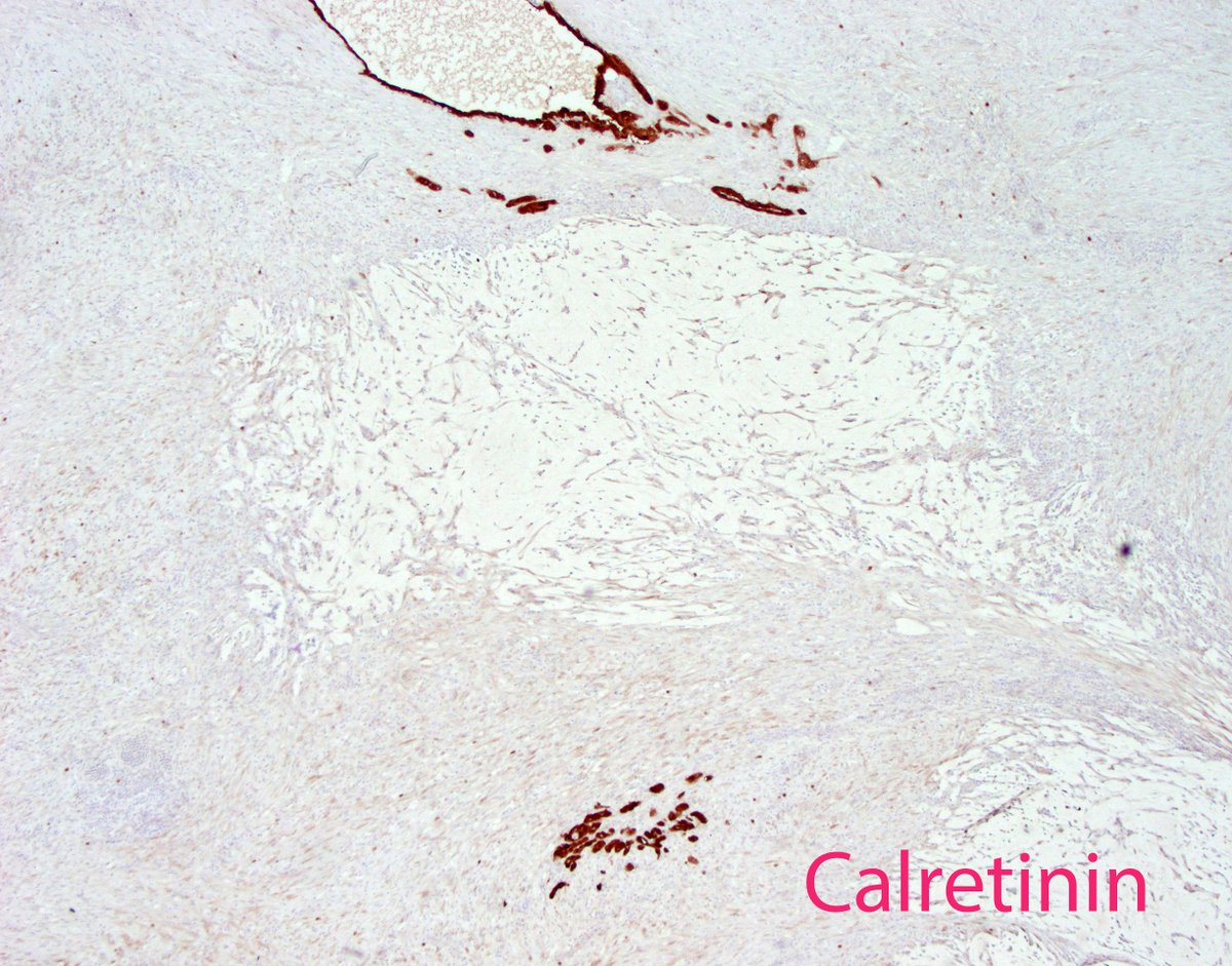 Pitfall alert in perforated appendicitis:  Detached CAM5.2 + cells can mimic malignancy. Key: calretinin coexpression and background organizing inflammation. Myofibroblasts appear in subserosal area around the perforation as highlighted with CAM5.2.  #GIpath #pathology