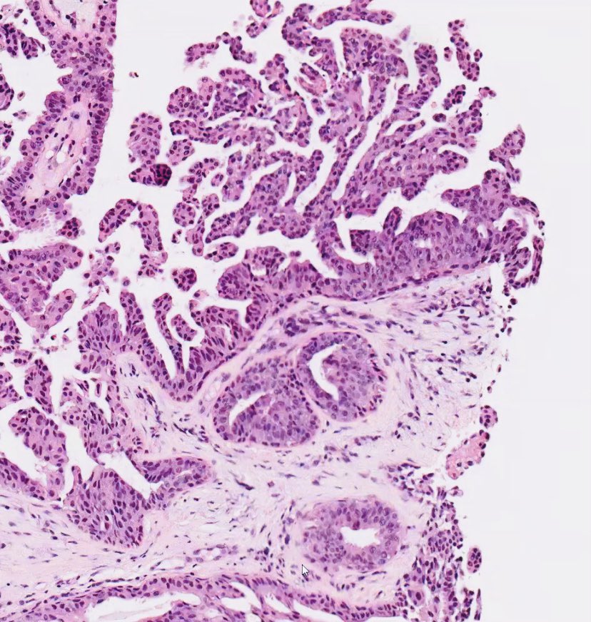 ac_pathgal's tweet photo. Breast lesion. Guesses! https://t.co/ql6ftPUy9m