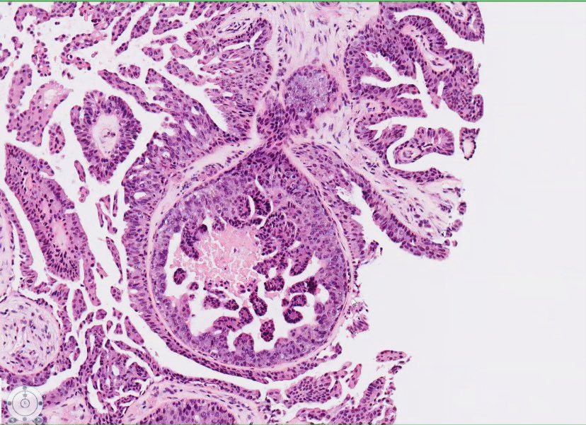 ac_pathgal's tweet photo. Breast lesion. Guesses! https://t.co/ql6ftPUy9m