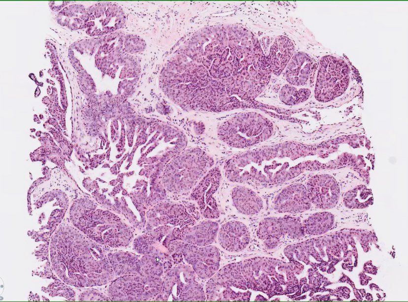 ac_pathgal's tweet photo. Breast lesion. Guesses! https://t.co/ql6ftPUy9m
