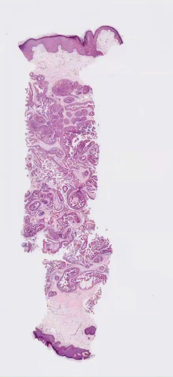 ac_pathgal's tweet photo. Breast lesion. Guesses! https://t.co/ql6ftPUy9m
