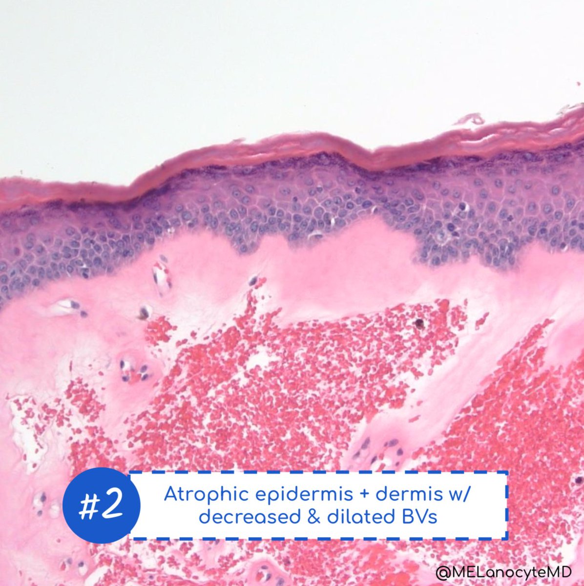 MELanocyteMD's tweet photo. Lichen sclerosus:
👩‍⚕️ PMP ♀️, vulva/perineum
👩‍⚕️ White "tissue paper" plaques
🔬 Atrophic ED
🔬 Homogenized papillary dermis (pushes inflammation down) + RBCs
🔬 BVs: ⬇️#, dilated
⚠️ Early: HP + HK, lichenoid + vacuolar
⚠️ ⬆️ Risk: differentiated VIN &amp; SCC
#dermpath #pathtweetorial https://t.co/jSwoOl1E7g
