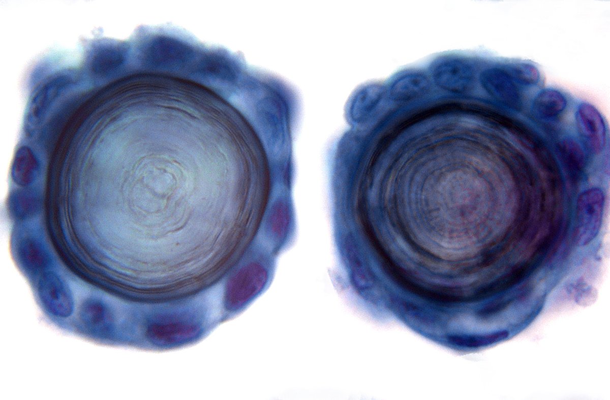 sza_jhcyto's tweet photo. Hidden Art - "Tree Trunks in Cross Section" or "Eyes Without a Face" - Psammomatous Effusion in a Metastatic Adenocarcinoma. https://t.co/SweiWioJ7h