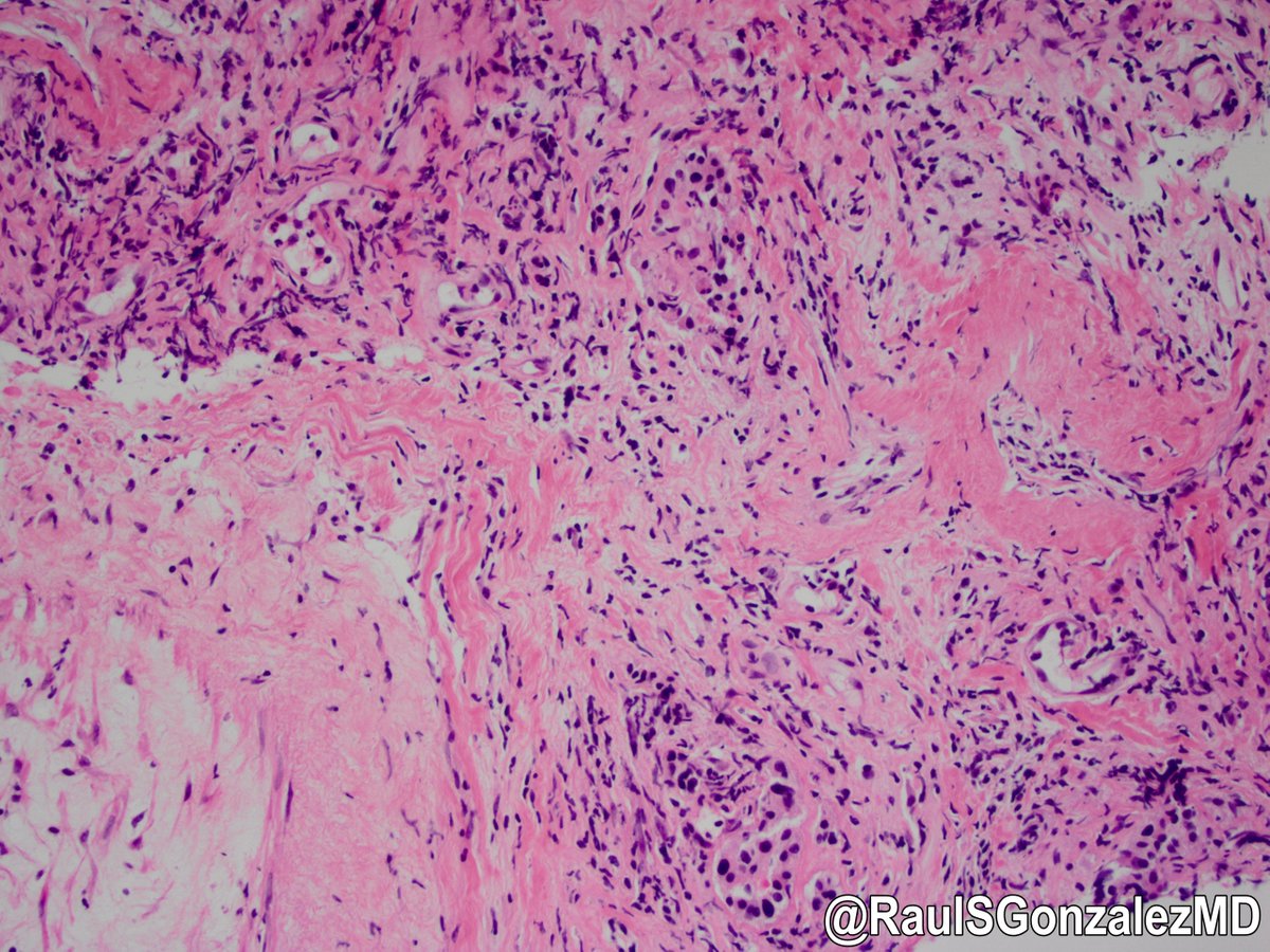 RaulSGonzalezMD's tweet photo. Case for over the weekend ... pancreas biopsy. #pathology #gipath https://t.co/MmkJOriaQS