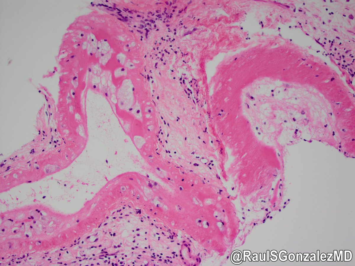 RaulSGonzalezMD's tweet photo. Case for over the weekend ... pancreas biopsy. #pathology #gipath https://t.co/MmkJOriaQS
