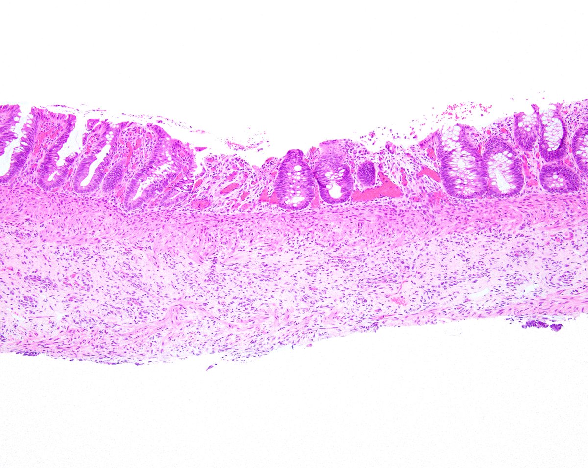LizMontgomeryMD's tweet photo. Aganglionosis/Hirschsprung's disease.  The acetylcholinesterase stain (an ancient histochemical stain) highlights presynaptic parasympathetic nerve twigs extending into the lamina propria because they cannot synapse on submucosal ganglion cells.  Calretinin shows loss of fibrils. https://t.co/4EbJSAmHAv