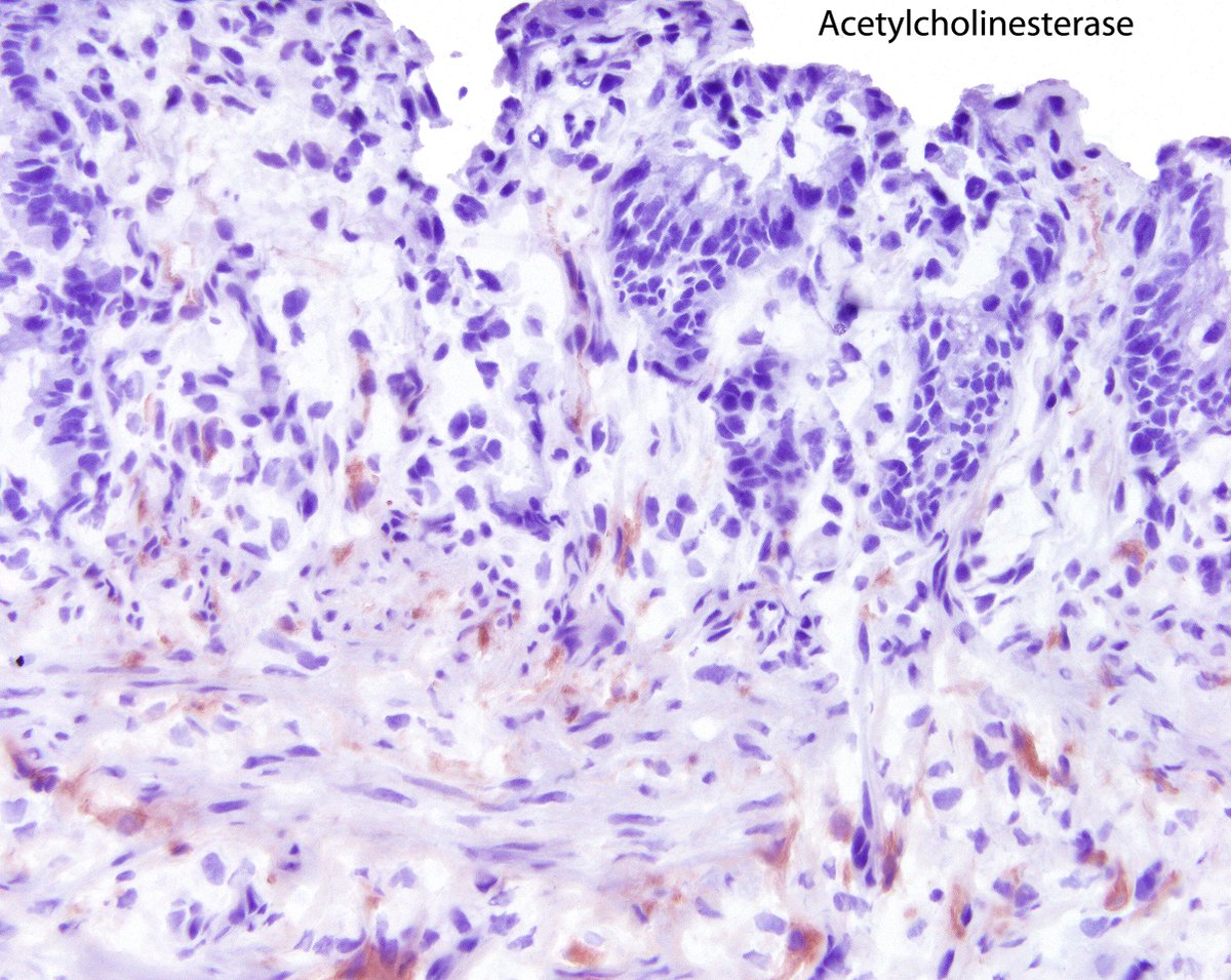 LizMontgomeryMD's tweet photo. Aganglionosis/Hirschsprung's disease.  The acetylcholinesterase stain (an ancient histochemical stain) highlights presynaptic parasympathetic nerve twigs extending into the lamina propria because they cannot synapse on submucosal ganglion cells.  Calretinin shows loss of fibrils. https://t.co/4EbJSAmHAv