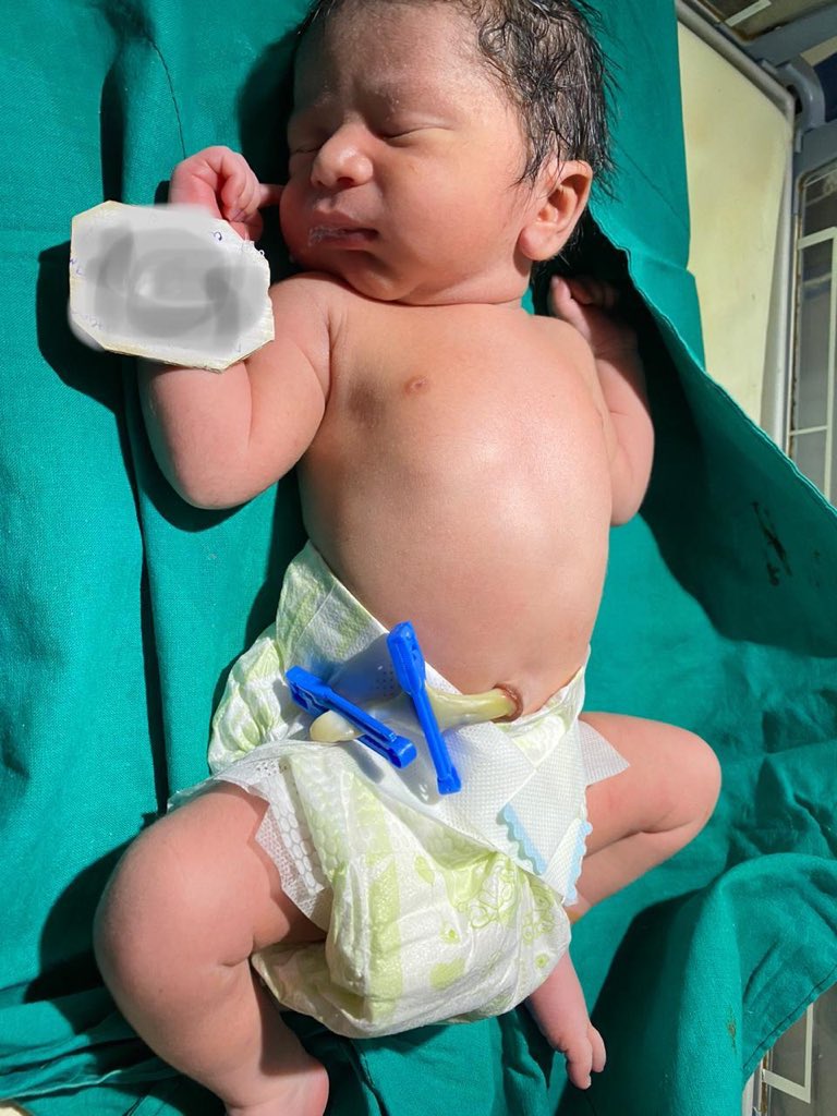 కరోన సోకిన నిండుచూలాలిలో ధైర్యం నింపి.. ప్రత్యేక జాగ్రత్తలతో ప్రసవం చేసి తల్లిబిడ్డలకు పునర్జన్మ ప్రసాధించిన మన గాంధీ హాస్పిటల్ వైధ్యులు దేశానికే ఆదర్శంగా నిలిచారు. ఆ కనిపించే దైవాలకు హృదయపూర్వక కృతజ్ఞతలు. తల్లి బిడ్డలు ఆరోగ్యంగా.. ఇంటికి చేరాలని కోరుకుంటూ శుభాకాంక్షలు