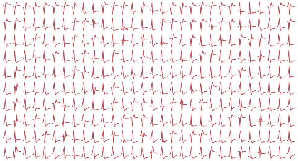nschawor's tweet image. Only amplitude (varies considerably) and latency (quite stable) is typically extracted from MEPs. The above trials were for a subject with a stable coil position, below for a possibly unstable one.🤔 Interesting article looking also at other MEP features: ieeexplore.ieee.org/document/87524…