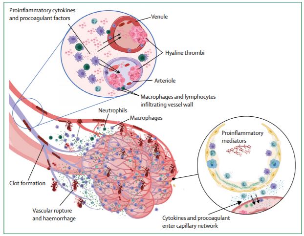 NEW VIEWPOINT—"Immune mechanisms of pulmonary intravascular coagulopathy in #COVID19 #pneumonia"

Dennis McGonagle et al discuss the vascular immunopathology associated with COVID-19 thelancet.com/journals/lanrh… #LancetRheumatology