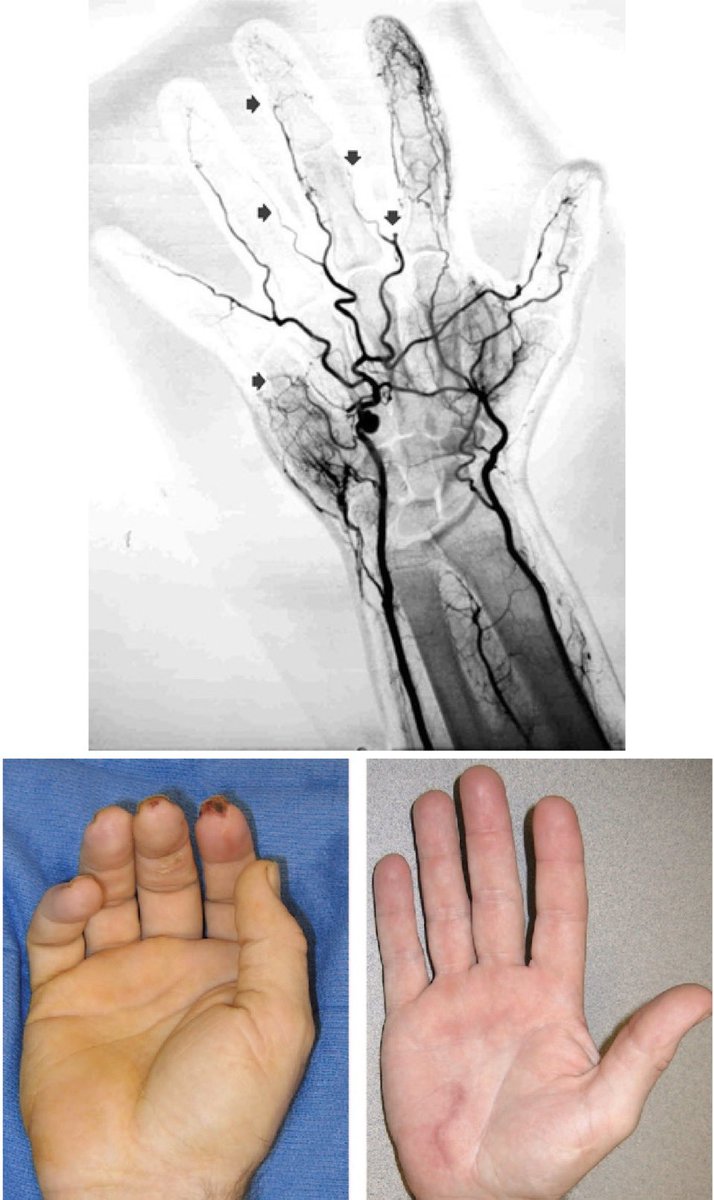 سلسلة تغريدات جمعت فيها أغلب متلازمات الأوعية الدمويه، لمحدودية الحروف