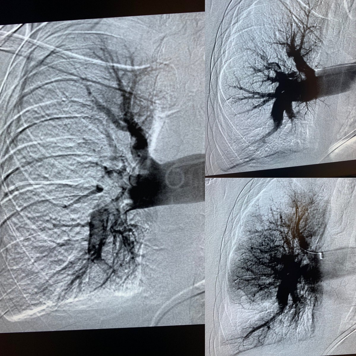 South Florida Vascular Specialists (@soflovir) on Twitter photo Another successful #FlowTriever PA mechanical thrombectomy in pt w/ massive PE
Mean PA pressure drop: 20 pts
HR 150s preprocedure➡️100 post
<a href="/arzybule/">Adam Zybulewski, MD</a> <a href="/BOlivieriMD/">Brandon Olivieri</a> @OmoKinju <a href="/HeidyReynolds5/">Heidy</a> <a href="/InariMedical/">Inari, now part of Stryker</a> <a href="/PERTConsortium/">The PERT Consortium®</a> <a href="/SIRRFS/">SIR RFS</a> Another successful #FlowTriever PA mechanical thrombectomy in pt w/ massive PE
Mean PA pressure drop: 20 pts
HR 150s preprocedure➡️100 post
<a href="/arzybule/">Adam Zybulewski, MD</a> <a href="/BOlivieriMD/">Brandon Olivieri</a> @OmoKinju <a href="/HeidyReynolds5/">Heidy</a> <a href="/InariMedical/">Inari, now part of Stryker</a> <a href="/PERTConsortium/">The PERT Consortium®</a> <a href="/SIRRFS/">SIR RFS</a>