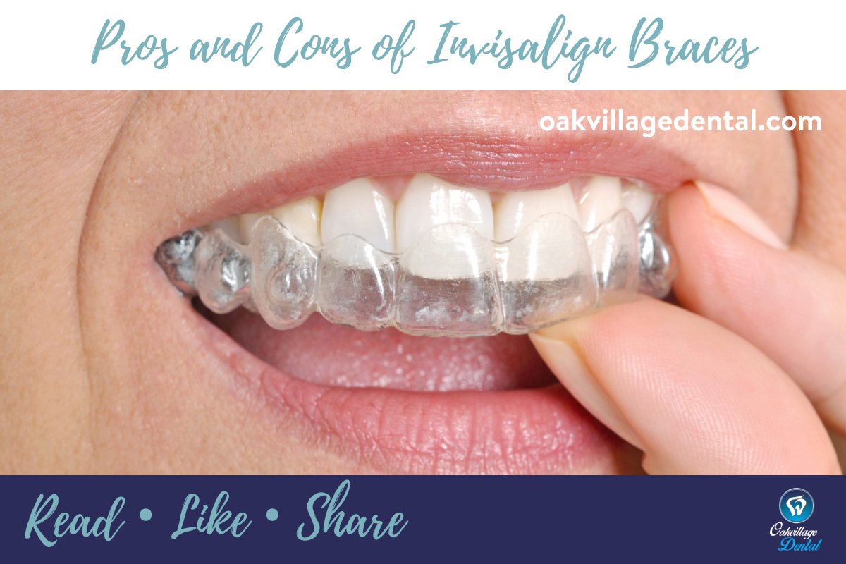 OakvillageDentl's tweet photo. Invisalign braces are easy to remove, so you can take them out when you eat, floss or brush your teeth.
https://t.co/IL7Ex9KmnI
#invisalignbraces #teethcare #oakvillagedental https://t.co/jJpjM63nbC