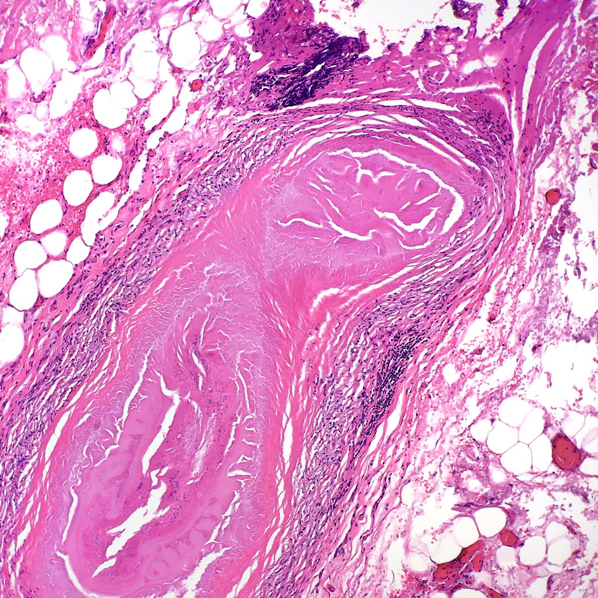 MFeelyDO's tweet photo. The surgeon was sure the porta hepatis lymph node they removed was positive for tumor. They found something alright. https://t.co/YGRMNRZj4W