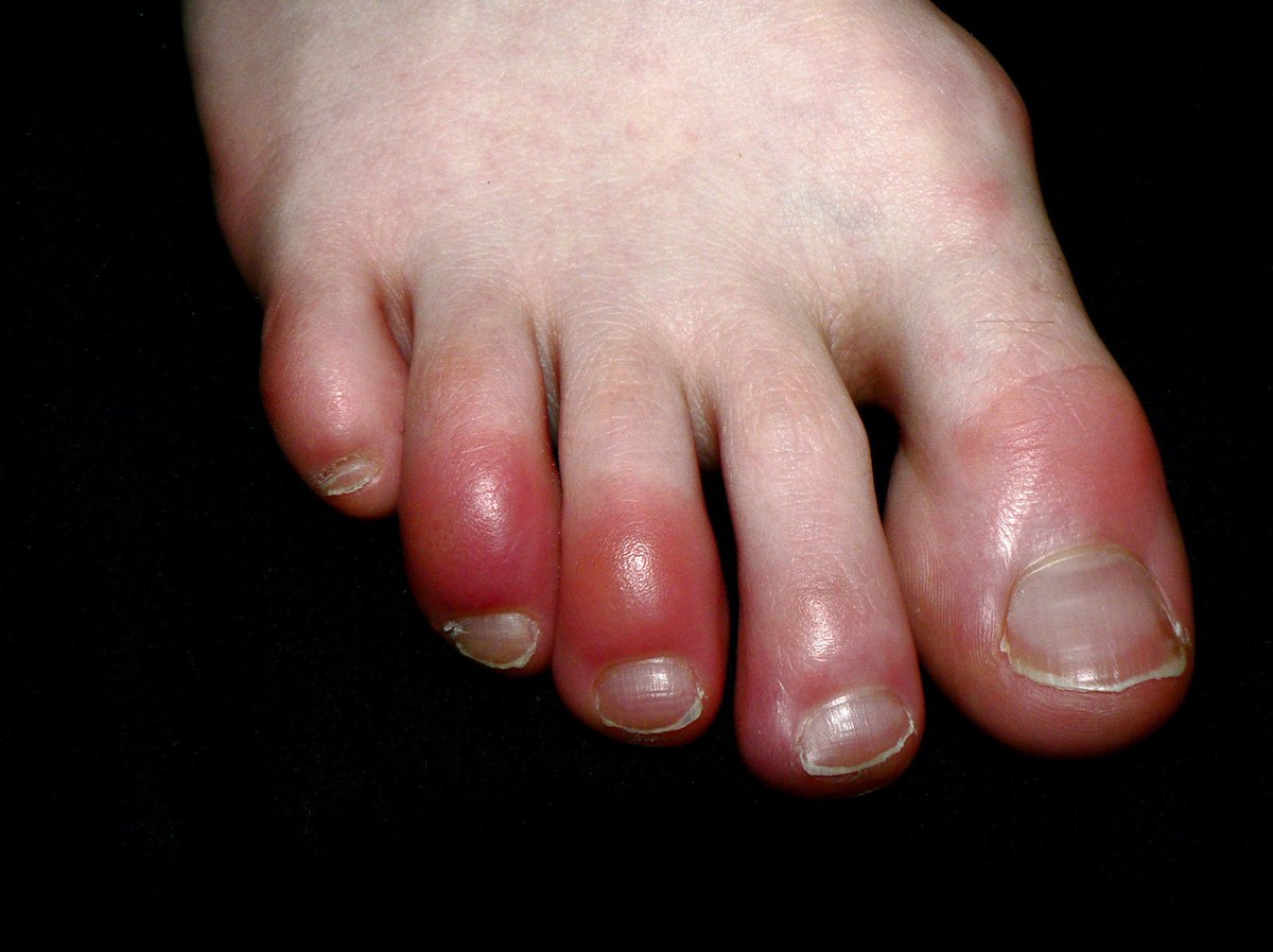 sdclyne's tweet photo. Reading about COVID toes and thinking about cold agglutinin disease. Does COVID cause a secondary CAD? We would see hemolysis in secondary CAD, right? Is anyone measuring cryoglobulins in these patients? @acweyand #COVID19 #AskNeph https://t.co/2IlKQTkoU7